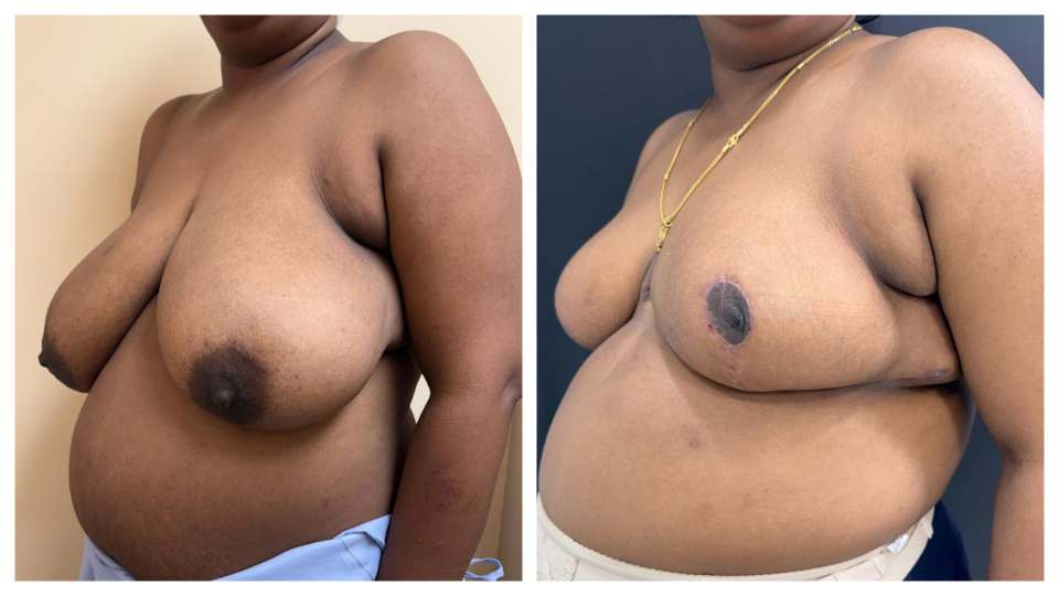 Patient Breast Implant